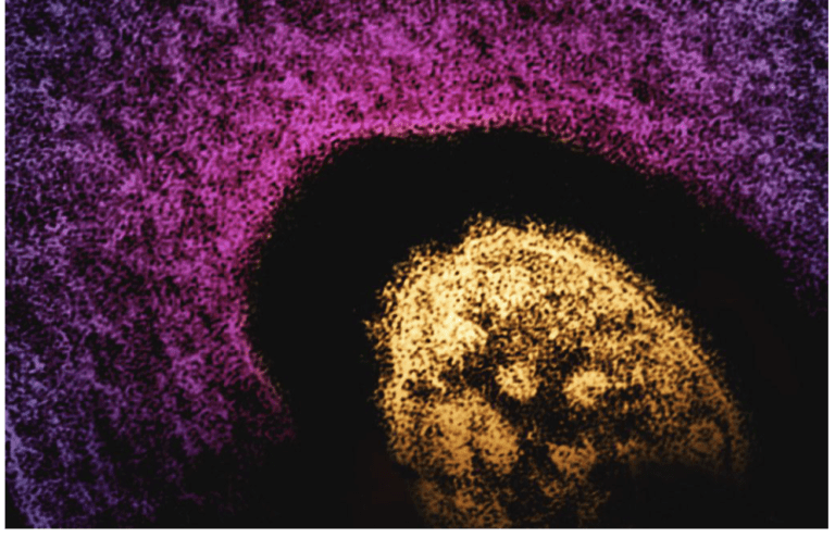 Why measles is on the rise in the U.S.: What Long Islanders need to know